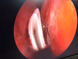 biodegradowalny opatrunek nosowy